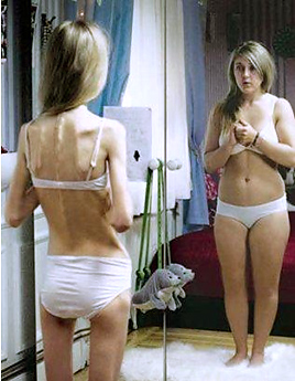 Нервная анорексия: снижение веса, опасное для жизни! 