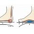 Что есть при плоскостопии