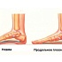 Костный бульон при плоскостопии для здоровых суставов и связок