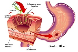 Что такое язва желудка?