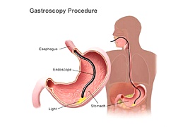 Какие болезни покажет гастроскопия? Как пройти ее безболезненно?