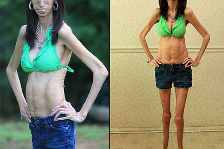 Лиззи Веласкес – самая худая женщина Америки