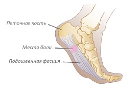 Подошвенный фасциит: ваша диета поможет справиться