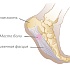 Подошвенный фасциит: ваша диета поможет справиться