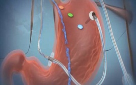 Электронный датчик в желудке спасет от ожирения
