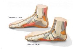 Питание против плоскостопия для укрепления связок и сухожилий. Самые необходимые продукты 
